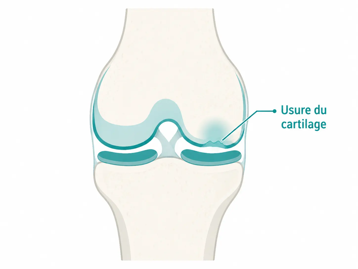 Illustration du genou montrant l'usure du cartilage articulaire caractéristique de l'arthrose