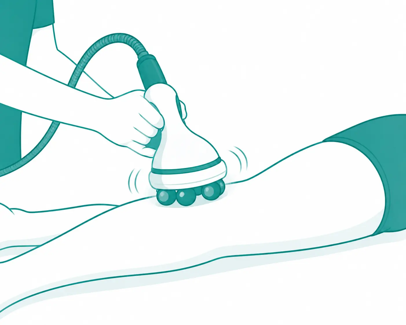 Illustration d'un appareil EndoSphères Therapy à sphères motorisées appliqué sur la peau
