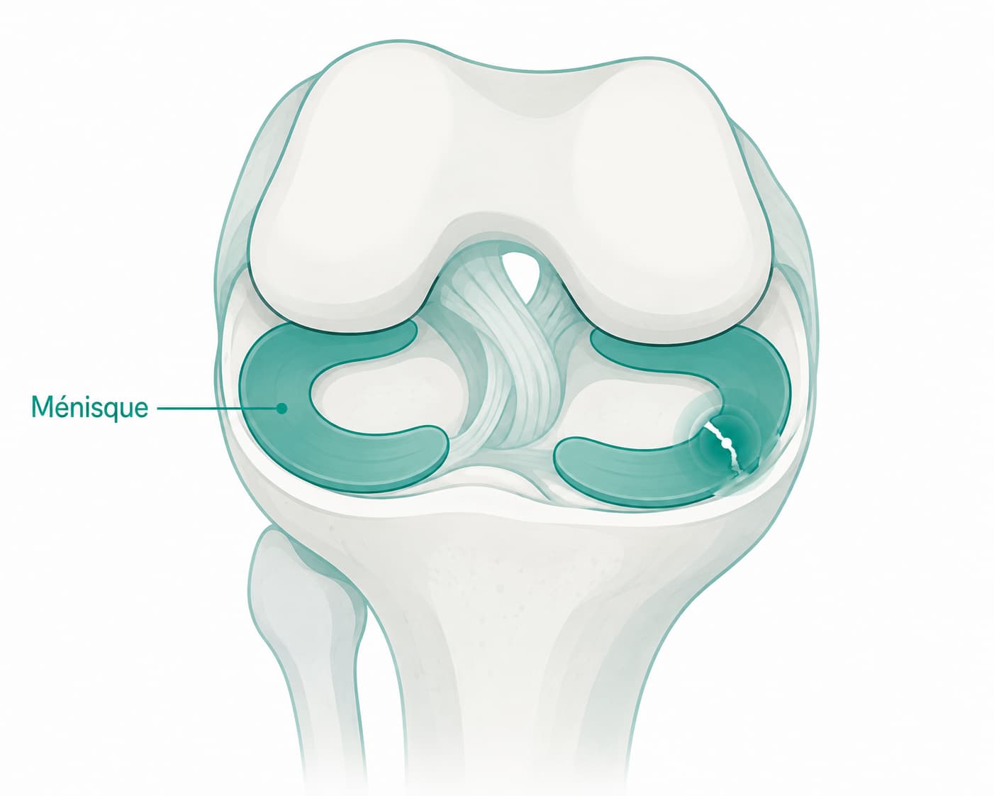 Illustration du genou montrant les ménisques entre le fémur et le tibia, avec une déchirure méniscale