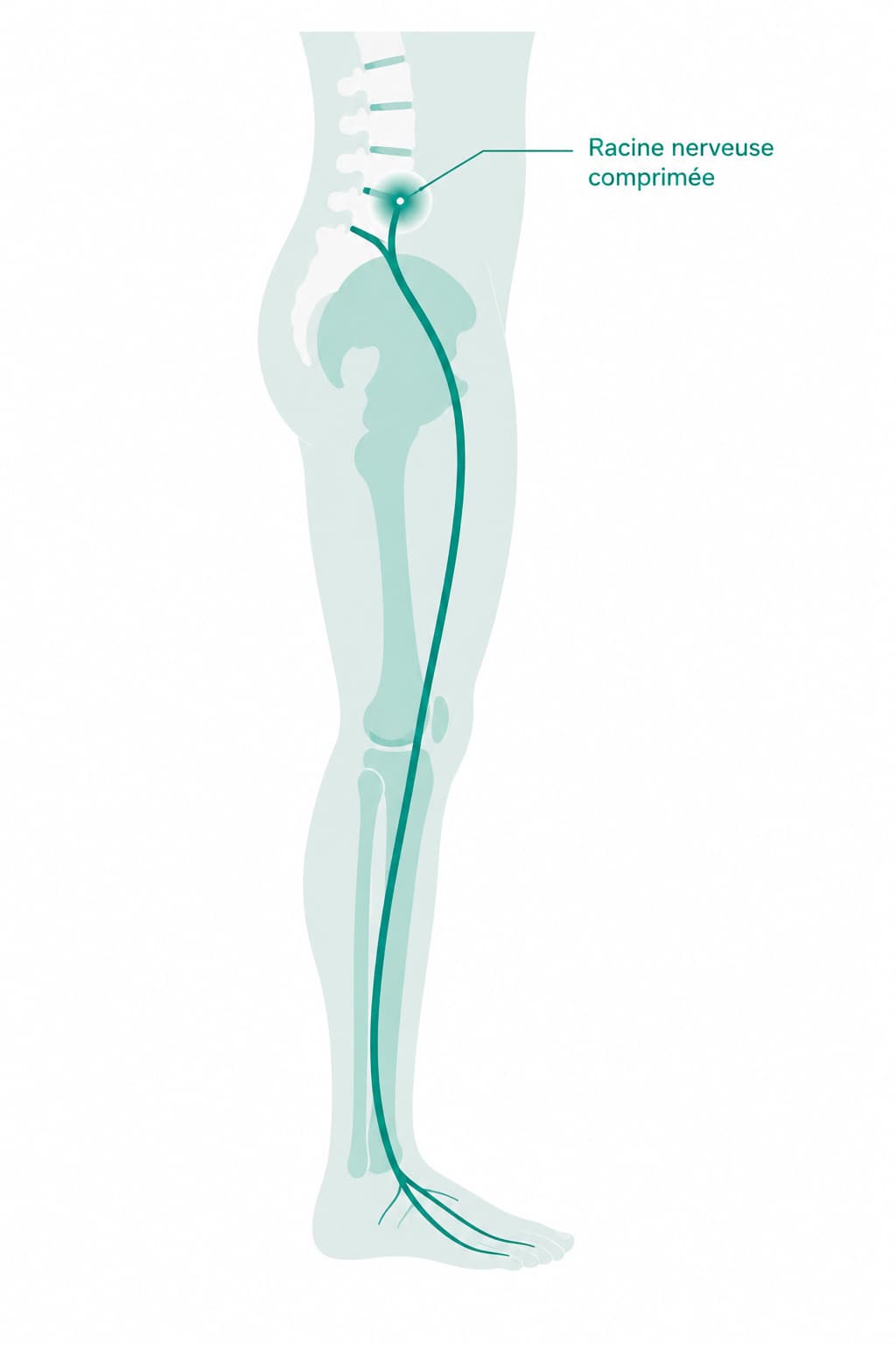 Illustration du trajet du nerf sciatique, du bas du dos jusqu'à la jambe, avec le point de compression de la racine nerveuse